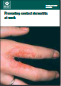 INDG233 (rev1) 03/07 Preventing contact dermatitis and urticaria at work